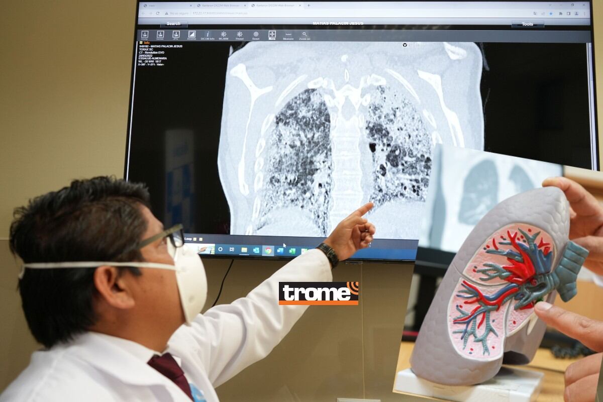 Gracias a donante, médicos especialistas y equipo adecuado se realizó exitoso trasplante de ambos pulmones en adulto mayor. (Isabel Medina / Compos, Trome / EsSalud)