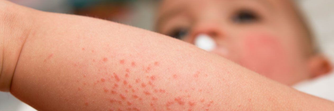 La dermatóloga señala que la mayoría de los sarpullidos ocurren cuando la piel entra en contacto con una sustancia que la irrita. Esto se conoce como dermatitis de contacto. (Foto: Difusión)