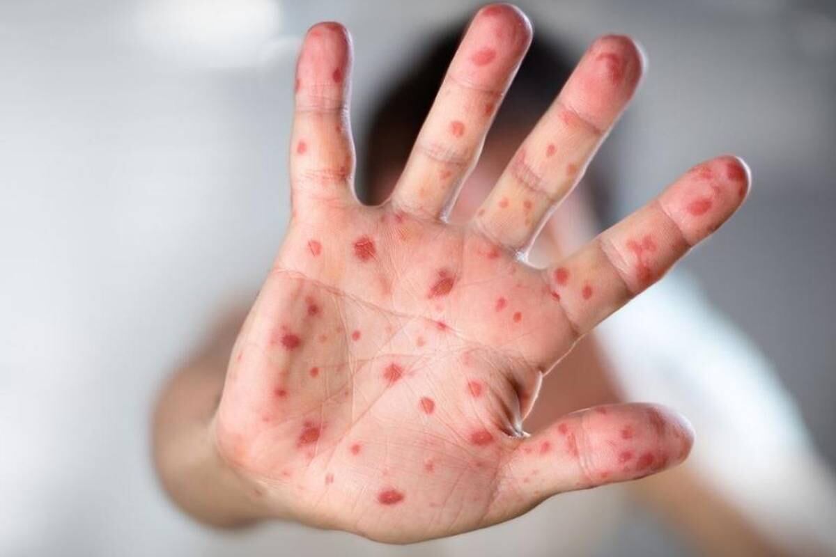 Conoce las pautas a seguir en caso presentes síntomas de la viruela del mono.