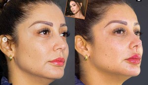 Karla Tarazona se hace retoquitos en la cara y aseguran que se quiere parecer a Pamela Franco