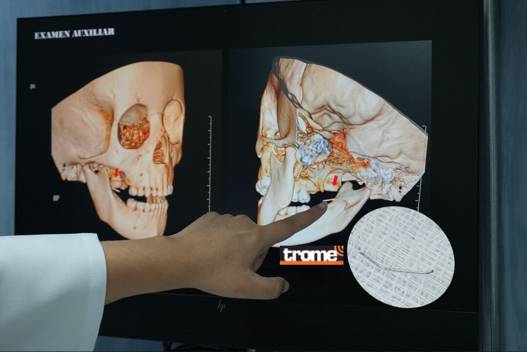 En el hospital Guillermo Almenara un equipo de médicos logró extraer con éxito la aguja que se incrustó en la mandíbula de una niña. (EsSalud / Isabel Medina / Trome).