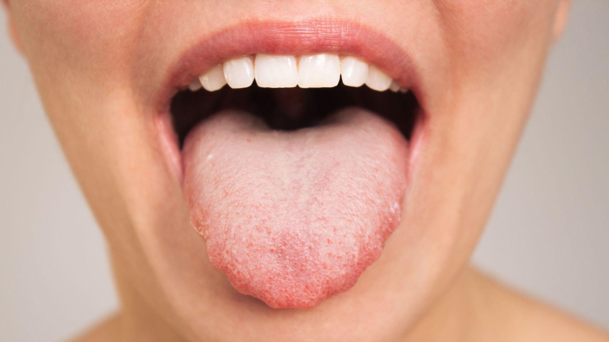 Las papilas gustativas son pequeños órganos sensoriales ubicados en la superficie de la lengua y otras áreas de la boca. Su función principal es percibir y enviar al cerebro las señales químicas de los alimentos, permitiéndonos identificar los cinco sabores básicos: dulce, salado, ácido, amargo y umami. Foto: Istock