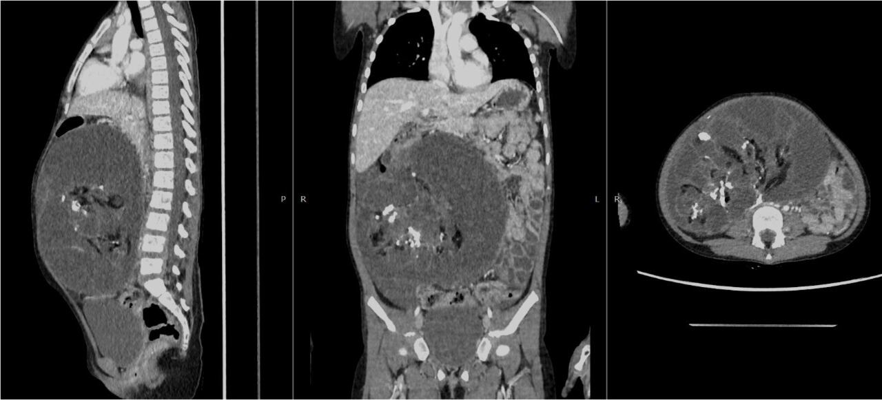 Pequeña regresó a casa con sus padre. (Foto: EsSalud)