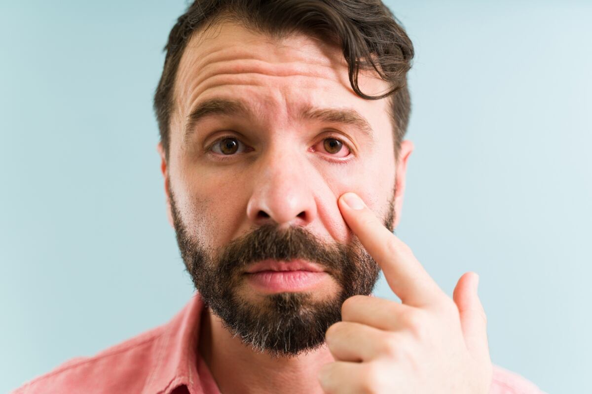 Conjuntivitis. Foto: Istock.