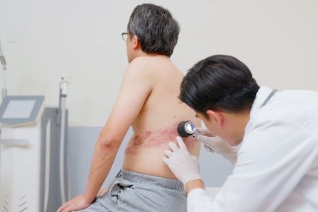 ¿Tuviste varicela? Podrías desarrollar Herpes Zóster