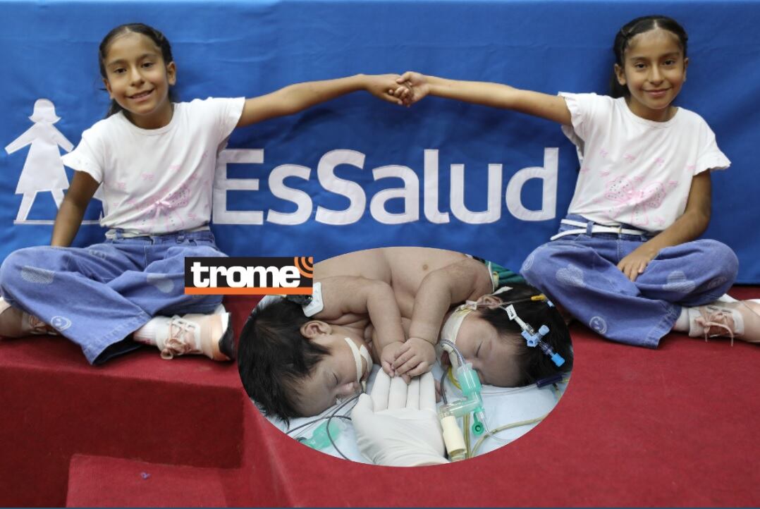 Exitosa intervención que las separó permitió salvar la vida de ambas y se mantienen con buena salud. (Isabel Medina / EsSalud / Compos. Trome).