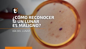 ¿Cómo reconocer si un lunar es maligno?