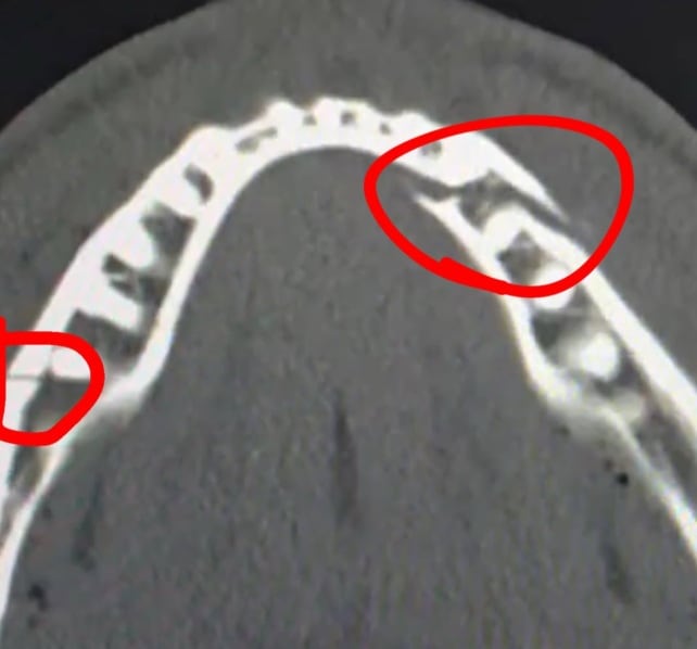 Jake Paul mostró la radiografía de cómo quedó su mandíbula. (@jakepaul)