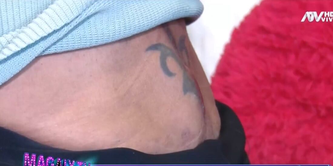 Lucy Bacigalupo mostró lo hinchada que tiene la zona baja de su espalda, lo que ocasiona que camine con dificultad.