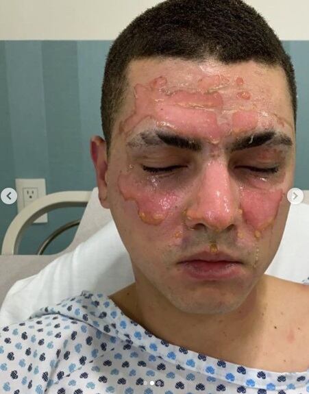 Omar Yubeili tuvo que ser sometido a una cirugía para que le fuera injertada piel en las lesiones (Foto: Omar Yubeili/ Instagram)
