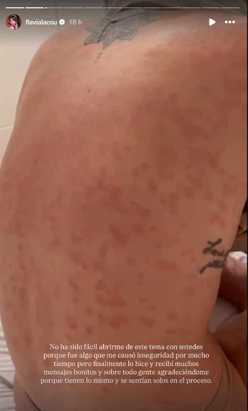 Actriz comparte imágenes de su psoriasis. (Instagram: @flavialaosu)