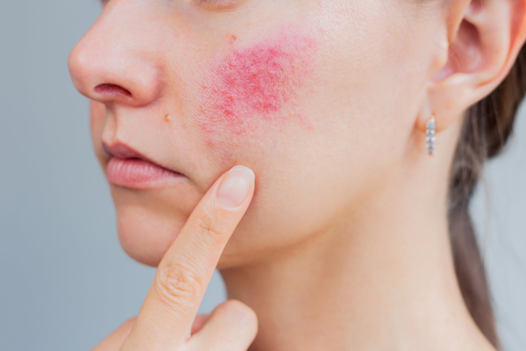 La dermatitis puede aparecer luego del contacto con agua contaminada de las piscinas. Se manifiesta con enrojecimiento, picazón o granitos en la piel. Foto: Istock