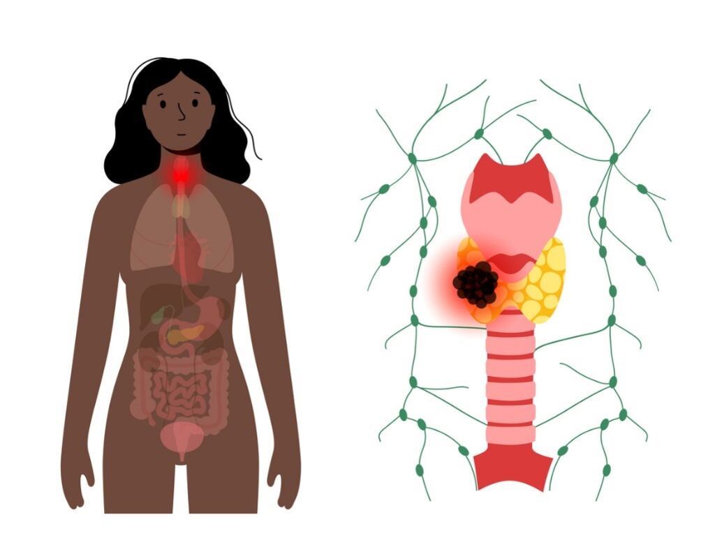 El cáncer de tiroides es la proliferación de células que comienza en la glándula tiroidea. Esta tiene forma de mariposa y se ubica en la base del cuello, debajo de la nuez de Adán. Foto: ¡Stock.