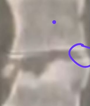 Laura Spoya habla de su vértebra rota