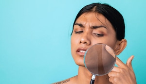 Cáncer de piel: la regla ABCDE para detectarlo a tiempo, sobre todo en verano