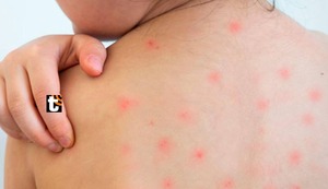 Sarampión: cuáles son los síntomas y cómo prevenir contagiarte de este virus