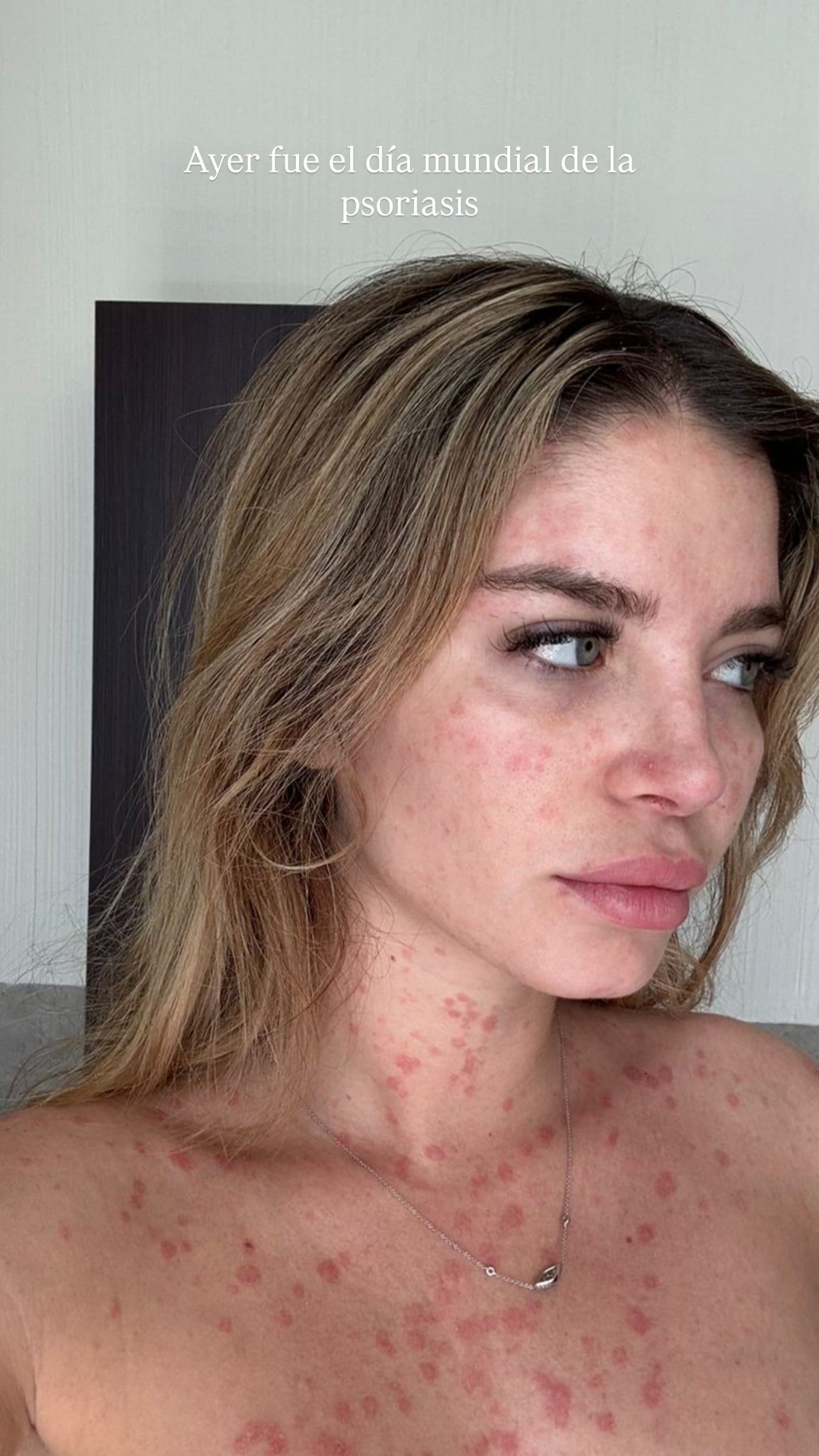 Actriz comparte imágenes de su psoriasis. (Instagram: @flavialaosu)