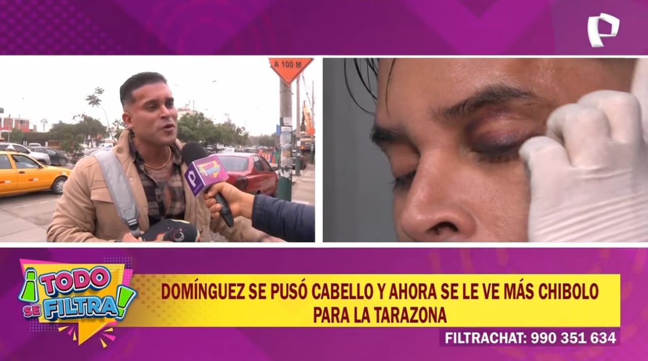 Christian Domínguez explica por qué reapareció con el ojo morado.