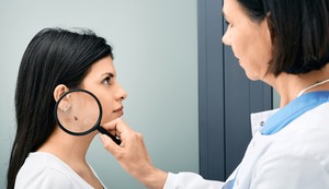 Mitos y verdades sobre el cáncer de piel que deberías saber ¡Anótalos y toma precauciones!