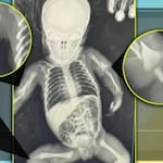 Bebé de un mes masacrada por sus padres en UCI: Tiene pierna, brazos y costillas rotas y hemorragia intracreaneal