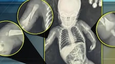 Bebé de un mes masacrada por sus padres en UCI: Tiene pierna, brazos y costillas rotas y hemorragia intracreaneal