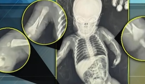 Bebé de un mes masacrada por sus padres en UCI: Tiene pierna, brazos y costillas rotas y hemorragia intracreaneal