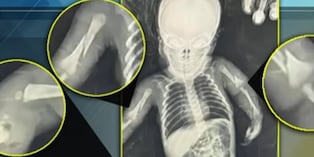 Bebé masacrada por sus padres está en UCI con fracturas, hemorragia intracraneal, desnutrición y anemia severa.