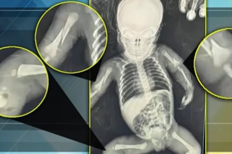 Bebé de un mes masacrada por sus padres en UCI: Tiene pierna, brazos y costillas rotas y hemorragia intra...
