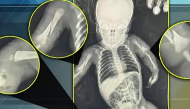 Bebé masacrada por sus padres está en UCI con fracturas, hemorragia intracraneal, desnutrición y anemia severa.