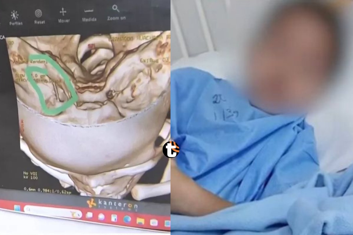 EsSalud informó que operación de pequeño Bayron fue exitosa.