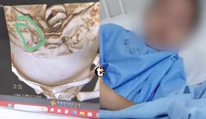 Villa María del Triunfo: Operan exitosamente a niño que terminó con una aguja en el cráneo tras visita dental