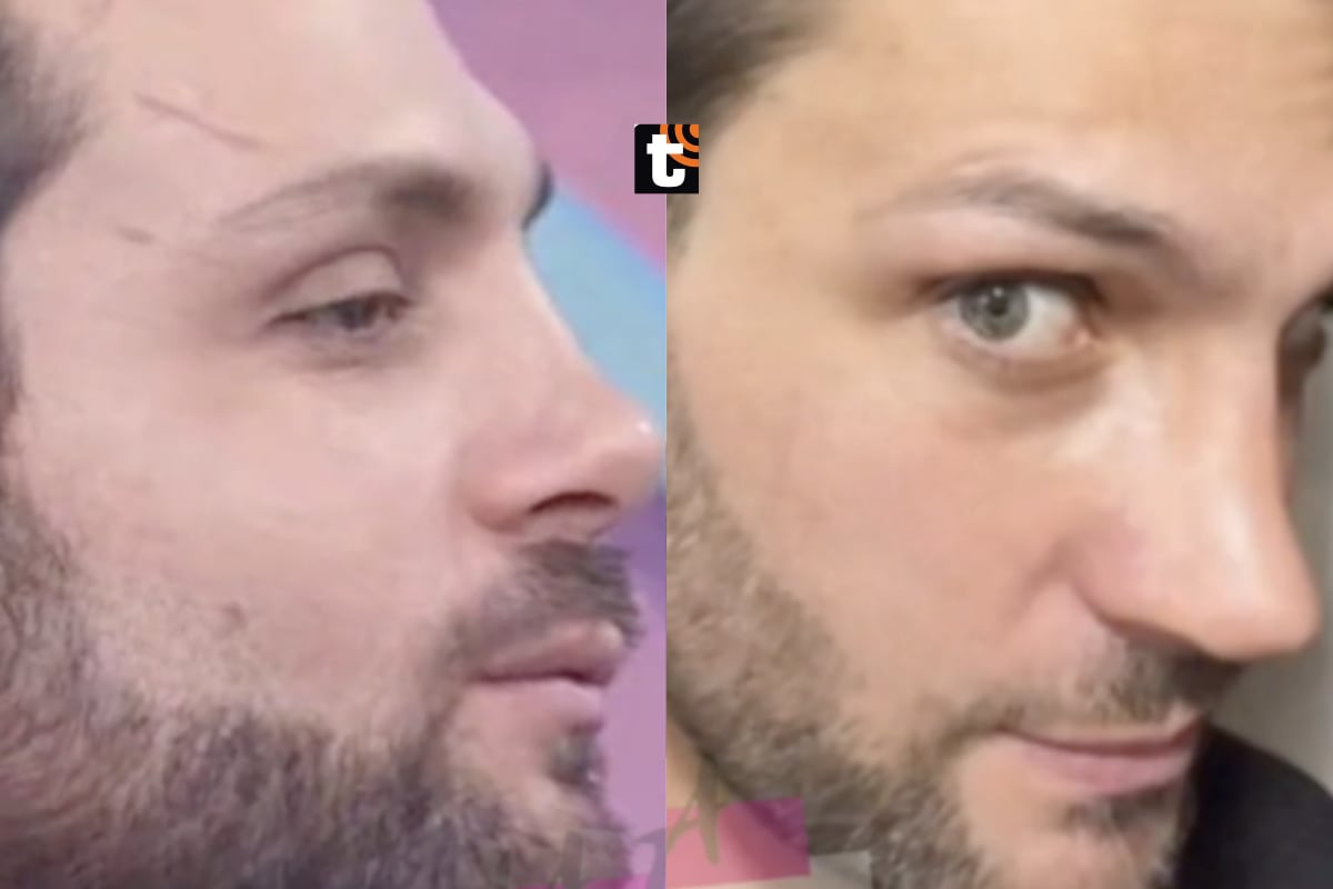 Nicola Porcella deja en shock al mostrar su nueva nariz tras someterse a operación y causa burlas en redes.