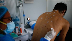 ¡URGENTE! OMS declara nuevamente emergencia médica mundial por brote de viruela del mono