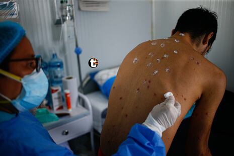 ¡URGENTE! OMS declara nuevamente emergencia médica mundial por brote de viruela del mono