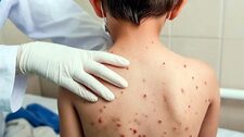 Gobierno declara la alerta sanitaria en 14 regiones por brote de sarampión