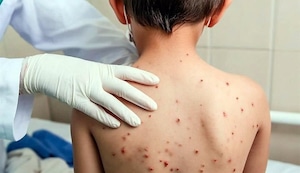 Gobierno declara la alerta sanitaria en 14 regiones por brote de sarampión
