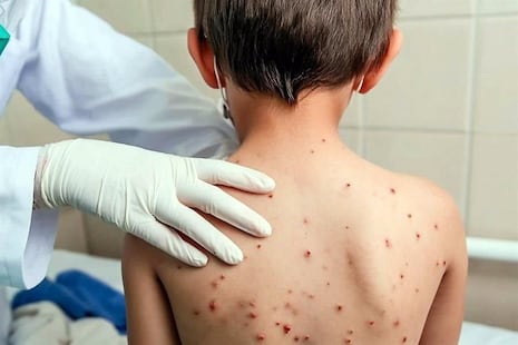 Gobierno declara la alerta sanitaria en 14 regiones por brote de sarampión