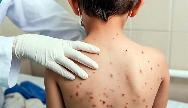 Gobierno declara la alerta sanitaria por sarampión. (Foto: Istock)