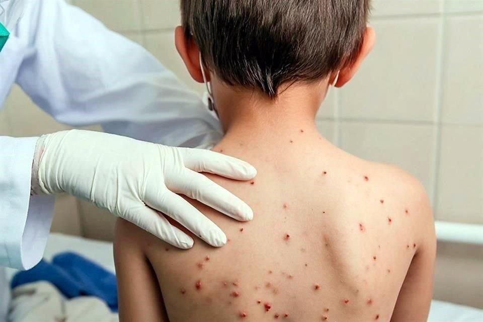 Gobierno declara la alerta sanitaria por sarampión. (Foto: Istock)