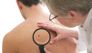 ¿Qué es un melanoma? ¿Qué factores intervienen en su aparición? ¿Qué puedo hacer?