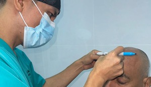 Trasplante de cabello: ¿Es para siempre? ¿Qué cuidados se debe tener?