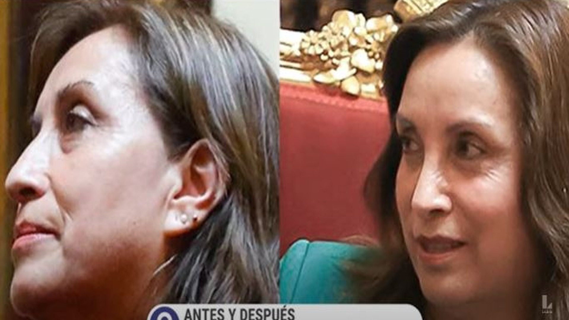 Dina Boluarte se sometió a cirugía estética y esta nuevamente en el ojo de la tormenta.