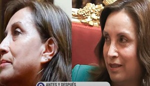 Dina Boluarte se sometió a cirugía plástica con doctor que operó a Magaly Medina | VIDEO