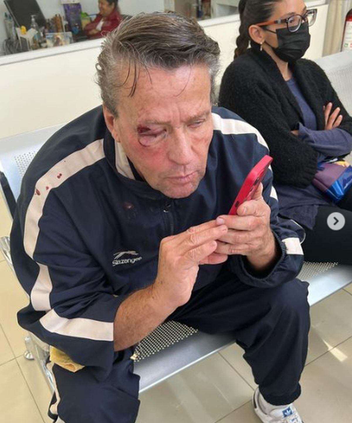 Así terminó la ceja y ojo derecho del actor tras ser agredido (Foto: Alfredo Adame / Instagram)