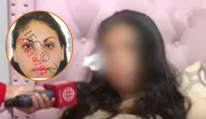 San Juan de Miraflores: joven quedó desfigurada tras ser atacada por la expareja de su novio