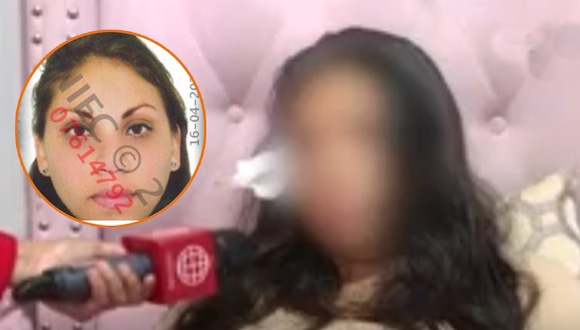 San Juan de Miraflores: Joven quedó desfigurada tras ser atacada por expareja de su enamorado