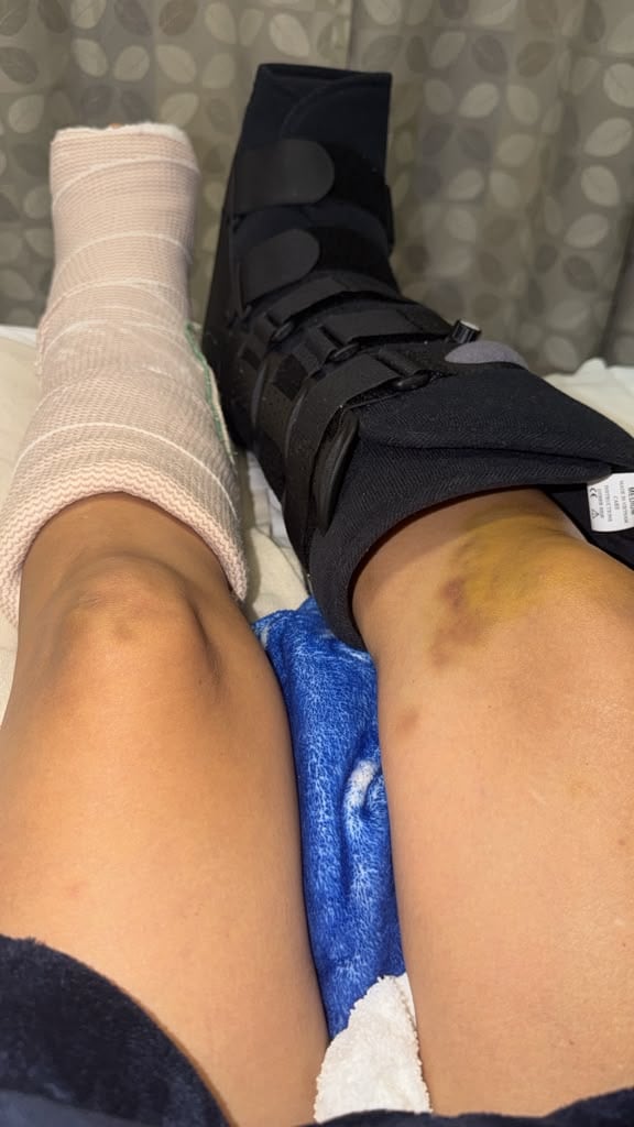 piernas fracturados.