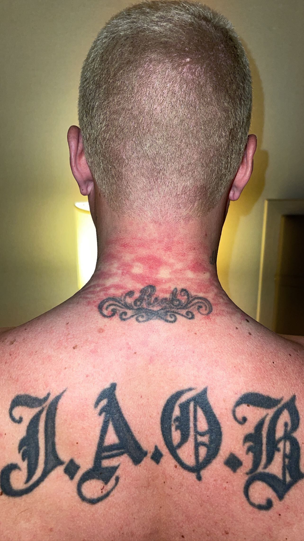 Así quedó el cuello de J Balvin tras el Met Gala 2021. (Foto: @jbalvin).
