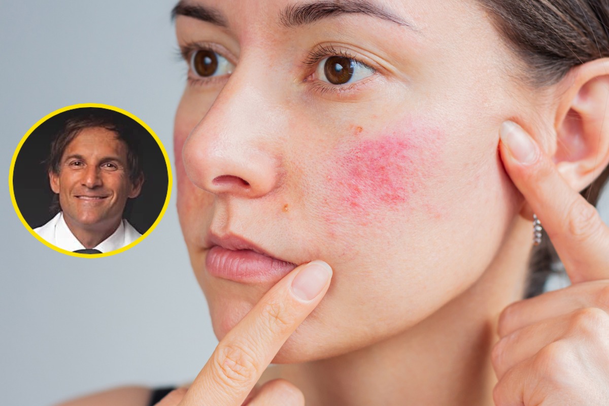 Experto explica qué es la rosácea. Foto: composición/Istock