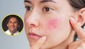 ¿Qué es la rosácea y cómo controlarla? Un experto lo explica